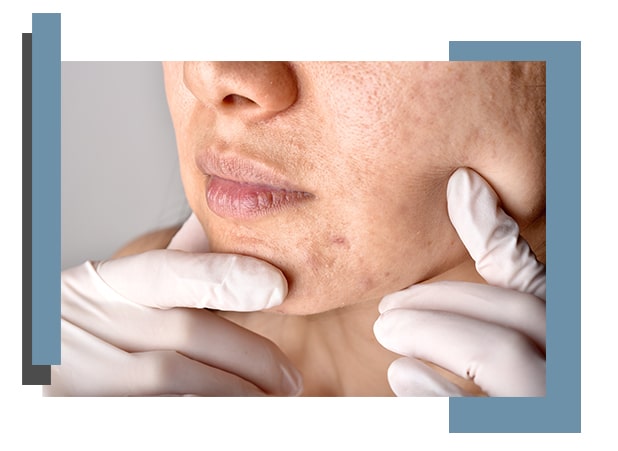 acne-scars-skin-treatments-ottawa-ontario