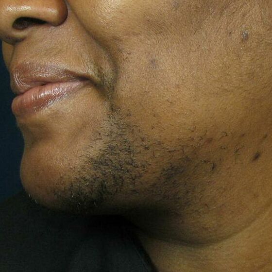 Before Cynosure Laser Hair Removal Treatment